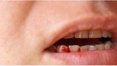 جلوگیری از خون ریزی لثه با دهانشویه خانگی