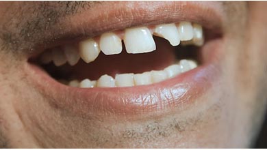 علت شکستن دندان چیست؟