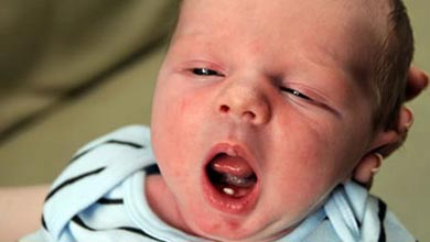 نوزادانی که هنگام تولد دندان دارند!