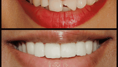 درباره لمینت دندان چقدر می‌دانید؟