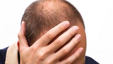 دلایل و درمان ریزش مو در طب سنتی