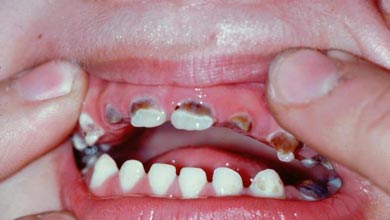 درصد پوسیدگی دندان کودکان