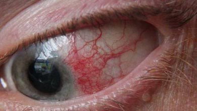 آنچه در مورد درمان انحراف چشم باید بدانید