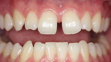 بیماری ایام میان‌سالی، جابجا‌شدن غیرطبیعی دندان‌ها