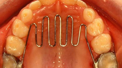 مرتب کردن دندان‌های نامرتب با ارتودنسی