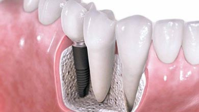 آیا امکان دارد ایمپلنت‌ دندان عفونت کند؟